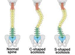 The image above shows the two types of spine shapes when you have Scoliosis and how it looks compared to a normal spine.